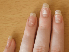 Белые пятна на ногтях — причины и приметы