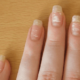 Белые пятна на ногтях — причины и приметы