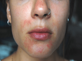 Причины развитие и способы лечения псориаза на лице