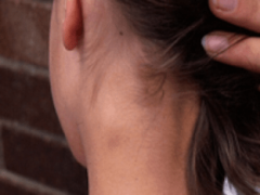 Как лечить воспаление лимфоузлов на шее?