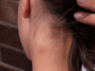 Как лечить воспаление лимфоузлов на шее