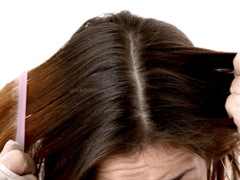 Может ли перхоть быть причиной выпадения волос?