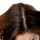 Может ли перхоть быть причиной выпадения волос?